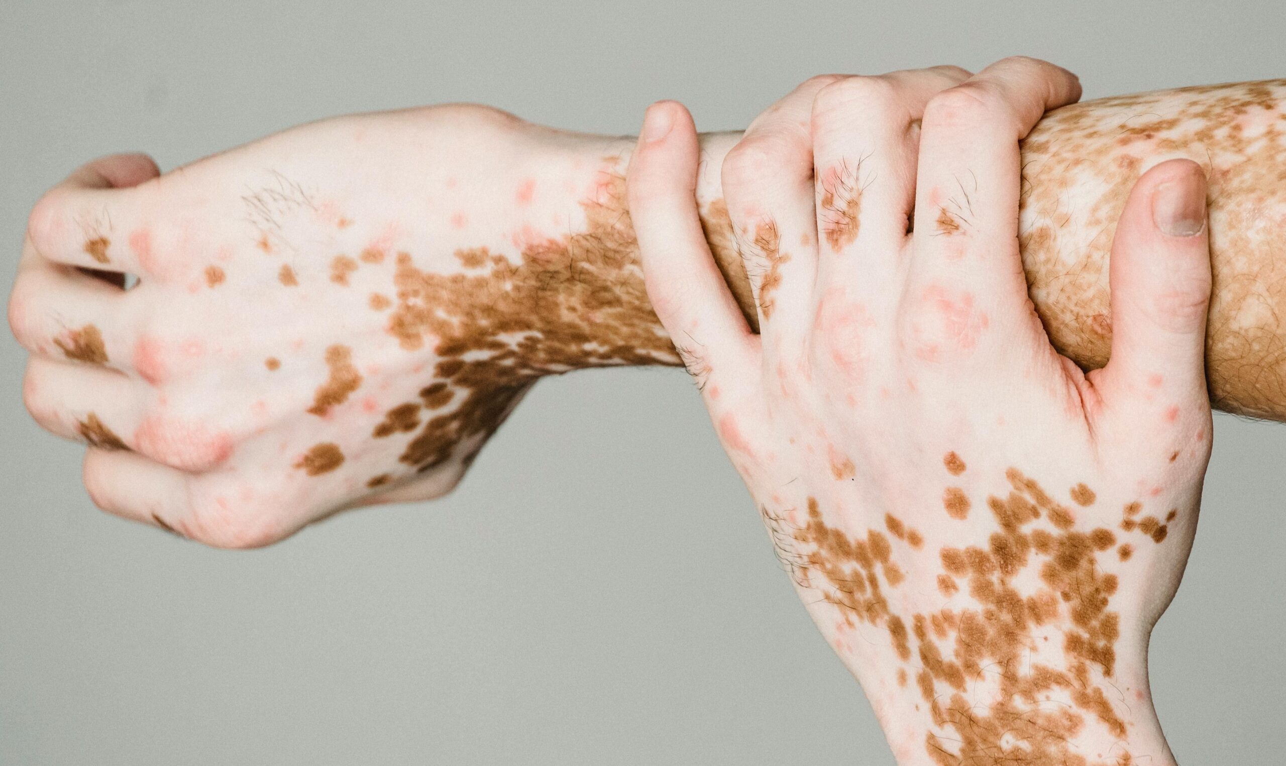 skin disorders